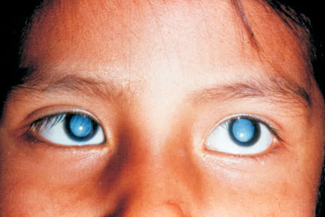 Como librarse de las arrugas bajo los ojos hasta
